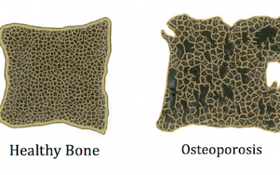 Focus On Osteoporosis