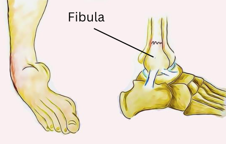 Fibula Fractures