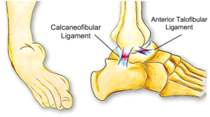 Can Poor Balance Lead To Ankle Sprains?